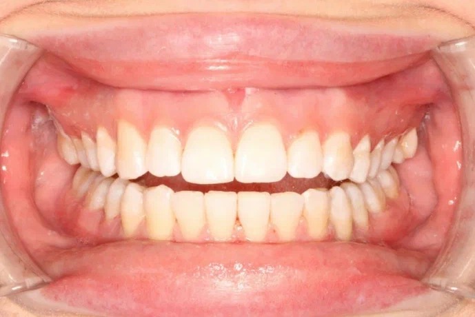 After image