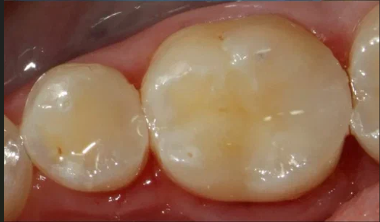 After image