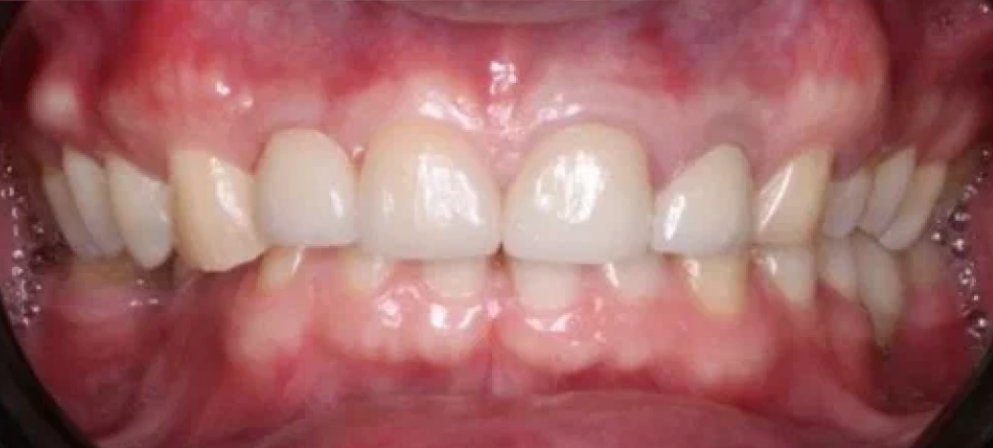 After image