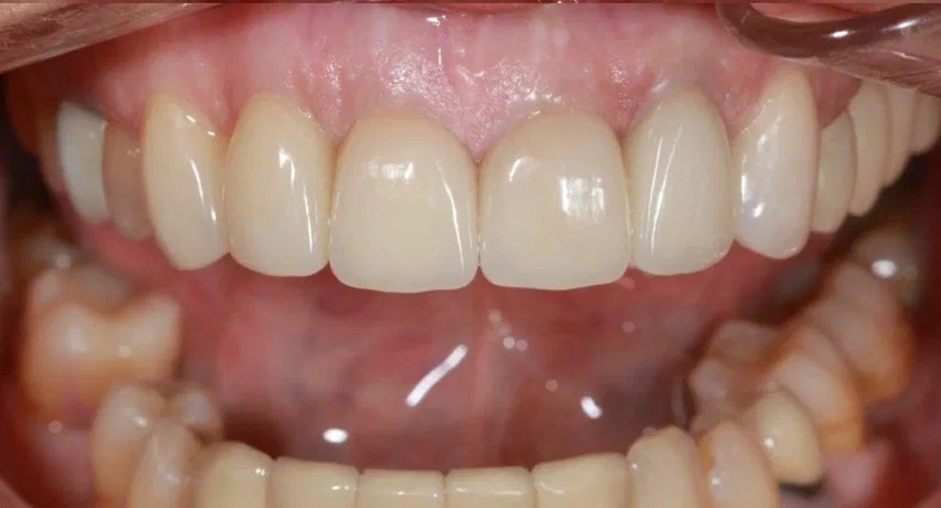 After image